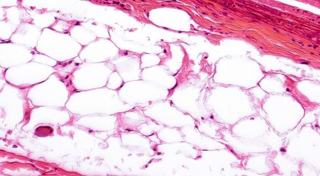 Adiposopatia: cos'è e come trattare la malattia del tessuto adiposo