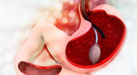 palloncino intragastrico-sezione stomaco