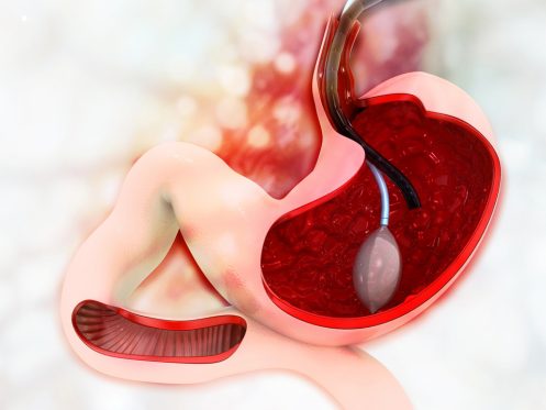 palloncino intragastrico-sezione stomaco
